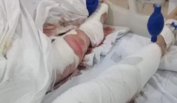 Imagen de Fue atacada por una jauría en Punta Mogotes y está en terapia intensiva